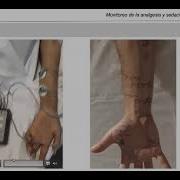 Webinar Monitoreo Sedación Y Analgesia En Pacientes Bajo Sedación Profunda Dr Federico Carini