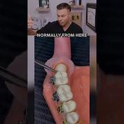 What ACTUALLY Happens In Wisdom Teeth Removal