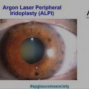Angle Closure Management A Logical Approach Based On Angle Closure Type And Mechanisms