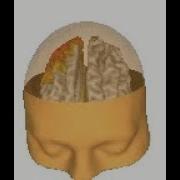 NeuroNavigator Hubs CSD And MRI Slices In NeuroGuide