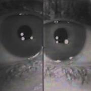 Horner S Syndrome Dilation Lag