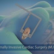 Medical Animation Minimally Invasive Cardiac Surgery MICS At Sarasota Memorial Hospital