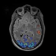 Mayo Clinic Minute Brain Mapping Improves Surgical Outcomes