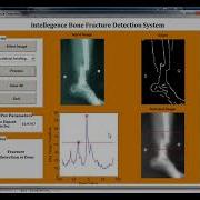 Bone Fracture Detection MATLAB Code MATLAB Project