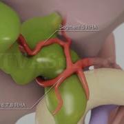 Resection Of A Type I Choledochal Cyst