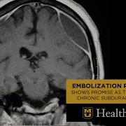 Embolization Procedure Shows Promise As Treatment For Chronic Subdural Hematoma Farhan Siddiq MD