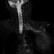 Brachial Plexus MRI With 3D CUBE STIR On GE HDXt