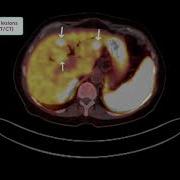 Neuroendocrine Tumor Gallium 68 DOTATATE PET CT