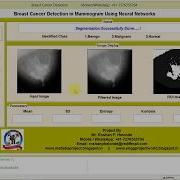 Matlab Code For Breast Cancer Detection And Classification In Mammogram Using Neural Network