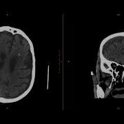 Neuroradiology Call Prep Cases Acute Subdural Hematoma CT Case 7 Discussion