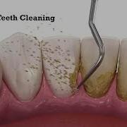 Scaling Teeth Cleaning Teeth Scaling Scaling And Polishing Dental Aesthetics