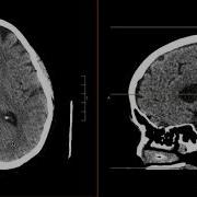 Intracranial Contents Part 2 Ventricular System