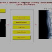 Bone Fracture Detection System Using Matlab Projects