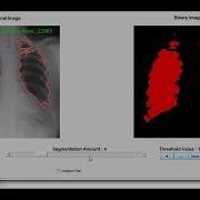 Lung Segmentation Glimpse A MATLAB GUI