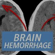 Emergency Radiology Case Series Acute Emergencies Of The Brain
