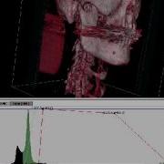 3D Volume Rendering