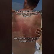 Don T Fry Day REMINDER Skincare Sunburn Fails