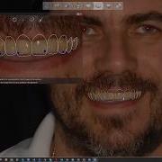 3Shape Dental System Snap On Smile Technique