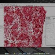 Breast Cancer KI67 Assessment Using With The Open Source QuPath