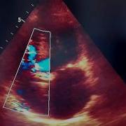 Iatrogenic Gerbode Defect Ventriculoatrial Septal Defect Complicating Aortic Valve Relacement