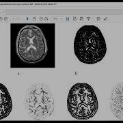 IMAGE SEGMENTATION BY MULTI RESOLUTION EDGE DETECTION AND REGION SELECTION FOR MRI BRAIN