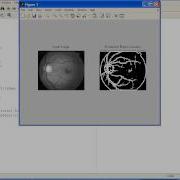Retinal Blood Vessel Extraction