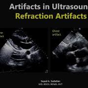 Artifacts In Ultrasound 4 Refraction Artifact