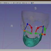 3D Slicer Dynamic Modeler Parametric Surface Editing For Biomedical Applications