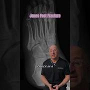 Tiny Fracture Huge Consequences Shorts