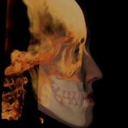3d Soft Tissue Simulation With Invivo5