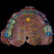Intraoral Scanning Technique With Primescan Scan Pattern For Best Accuracy