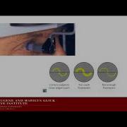 Introduction To Glaucoma