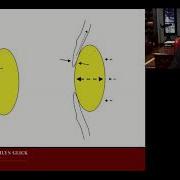 Лекция Закрытоугольная глаукома первичная и вторичная