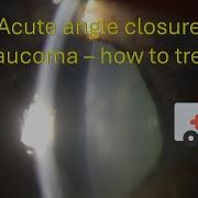 0060 Acute Angle Closure Glaucoma How To Treat