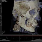 OnDemand 3D Ceph ModuleX Ray Generation
