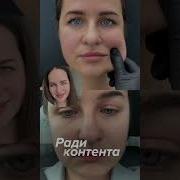 Последствия филлеров спустя 10 лет косметологияспб косметолог филлеры последствия