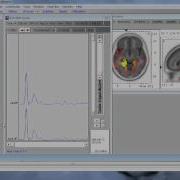 SLORETA Basics Tutorial