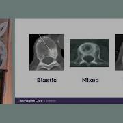 Living With And Treating Bone Metastasis