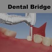 Dental Bridge Animation 3D