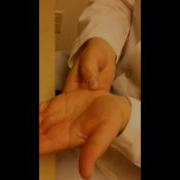 Blunt Trauma To The Wrist