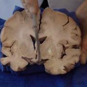 The Visual Pathway Neuroanatomy Video Lab Brain Dissections ARCHIVE