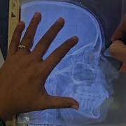 HOW TO TRACE A LATERAL CEPHALOGRAM ORTHODONTIC TUTORIAL