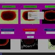 Blood Group Detection Using Matlab