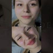 Выбираем филлер для губ присмотритесь к коллекции Арт Филлер ART Filler