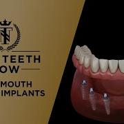 Full Mouth Dental Implant Procedure