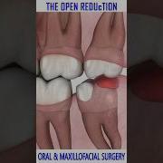 WISDOM TOOTH REMOVAL ANIMATION