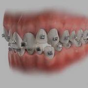 Self Ligating Braces Metal