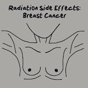 Doctor Explains Radiation Side Effects For Breast Cancer