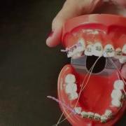 Placing A Stainless Steel Ligature Wire For Braces