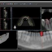 Segmenting Tooth From CT Using Virtual Teeth